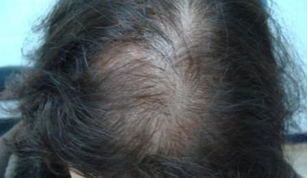 alopecie-androgenetique-exemple-1