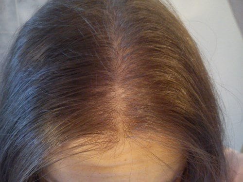 alopecie-androgenetique-exemple-2