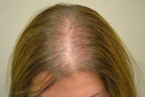 alopecie-androgenetique-exemple-3