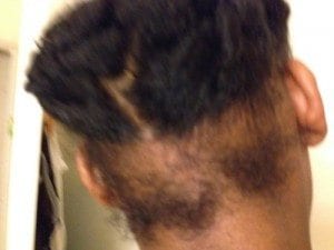 alopecie-traction-exemple-1