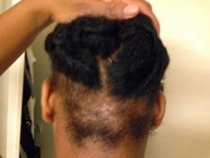 alopecie-traction-exemple-2