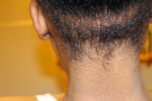 alopecie-traction-exemple-3