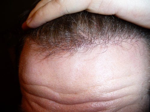 La calvitie frontale se manifeste par la perte des cheveux au niveau du front