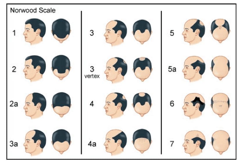 Classification de Hamilton-norwood qui explique l'évolution et la progression de la calvitie et de la perte de cheveux