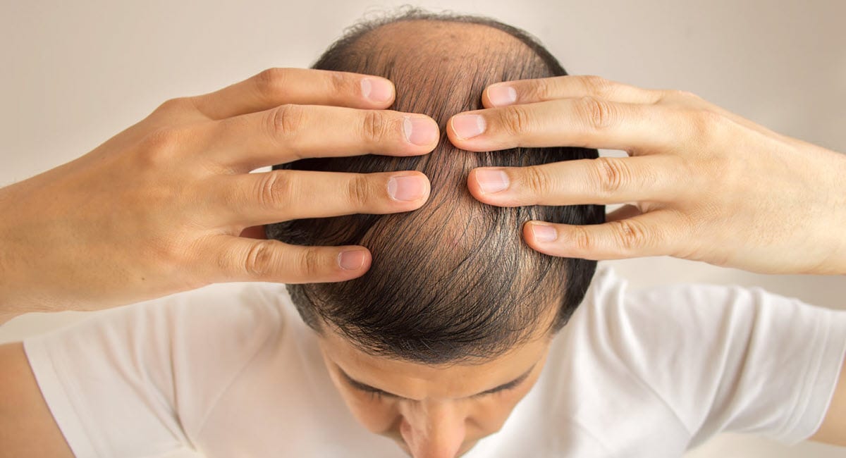 L'illustration de l'article "Hérédité et la perte de cheveux : quelles solutions ?"