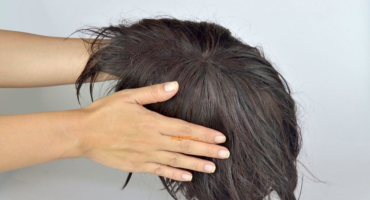 Les femmes peuvent avoir le recours à la prothèse capillaire en cas de perte de cheveux