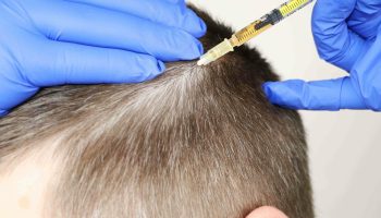 Mésogreffe capillaire: la solution innovante pour stimuler la repousse des cheveux et leur régénération